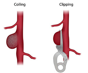 Illustration of aneurysm coiling and clipping