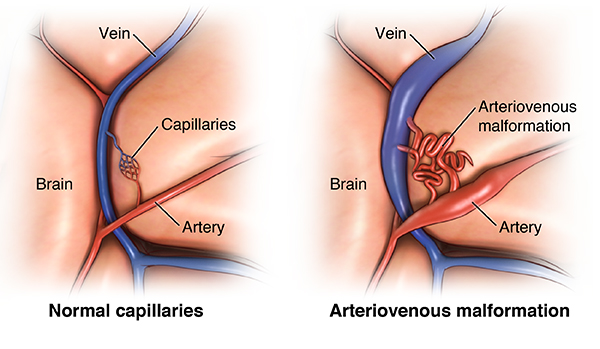 Arteriovenous malformation in a cerebral aneurysm