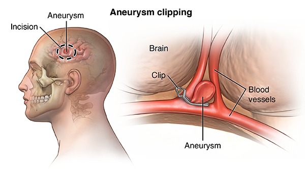aneurysm clipping - Munson Healthcare