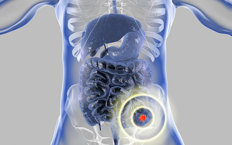 Illustration of human body with colon highlighted
