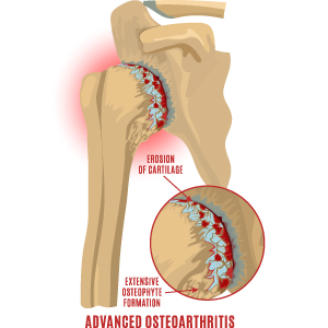 Diagram of shoulder illustrating osteoarthritis